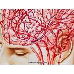  Artwork of cerebral embolism, cause of stroke Photographic 